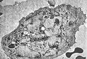 F,16y. | bone marrow - malignant histiocytosis